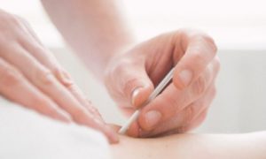 DRY NEEDLING THERAPY