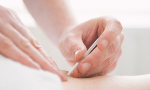 DRY NEEDLING THERAPY